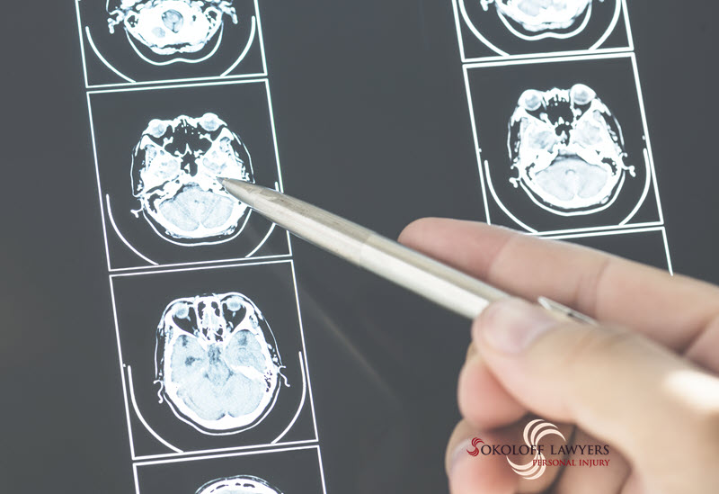 Brain Damaged Injuries? Lawyers Can Help You Get Compensation